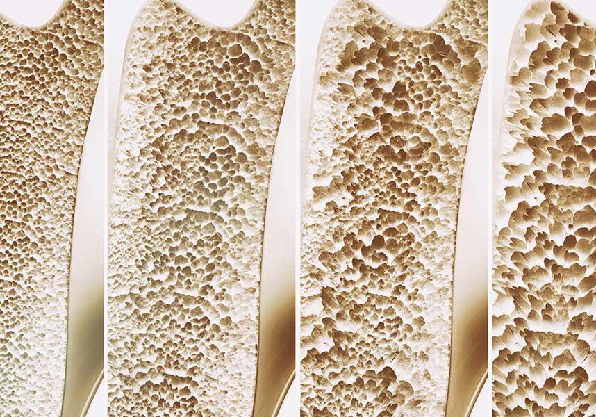 Bone density comparison in four stages